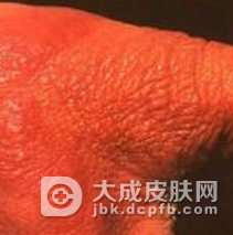 发生类丹毒应该要怎么办