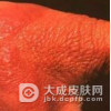 发生类丹毒应该要怎么办