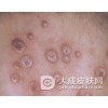 得了三期梅毒如何护理