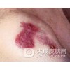 梅毒三期有什么特征