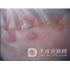 性病梅毒三期的表现症状