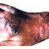 引起皮肤结核病的病因是什么