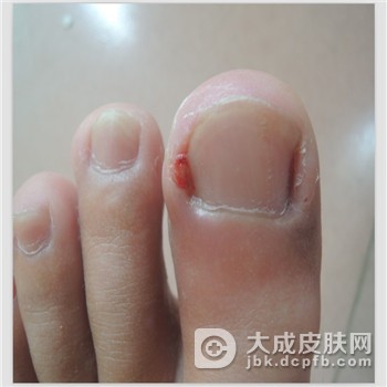 如何避免甲沟炎