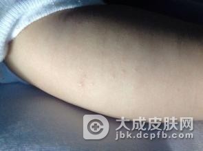 要注意传染性软疣日常生活中的预防
