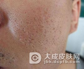 寻常性痤疮的症状体现在哪些方面