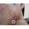 寻常型痤疮的相关内容