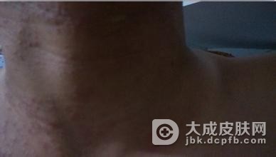 换季皮肤过敏的症状有哪些