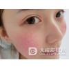 红血丝治疗的注意事项