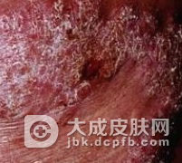 皮肤结核病的预防方法是什么