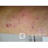在夏季皮炎应该从哪些方面来了解