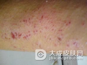 在夏季皮炎应该从哪些方面来了解