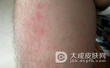 夏季皮炎激素类药膏使用要遵医嘱
