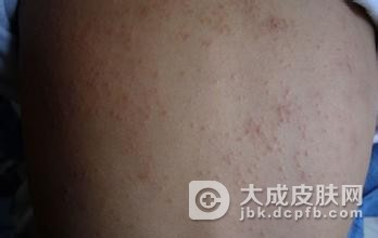 夏季三类皮炎易高发，做好预防很重要