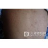 夏季三类皮炎易高发 做好预防很重要