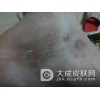 慢性湿疹为什么会反复发作呢