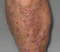 皮肤结核病都有哪些皮损特点