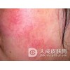 红血丝能彻底根治吗