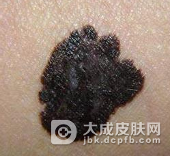 该怎样预防恶性黑色素瘤