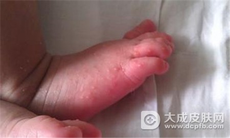 婴儿脚上起小水泡湿疹怎么办呢