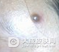 恶性黑色素瘤的中医治疗及饮食调节