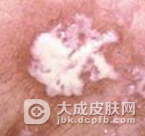 皮肤念珠菌病的发病特点是什么