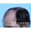 脂溢性脱发典型的症状有哪些