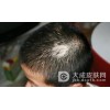 怎样自我诊断脂溢性脱发