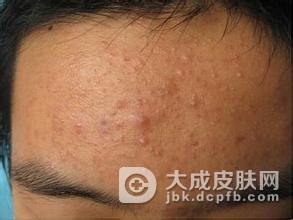痤疮的典型症状