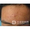 痤疮的典型症状
