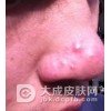 专家介绍如何识别痤疮类型
