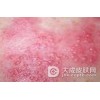 如何治疗单纯性疱疹不容易复发