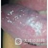 口腔粘膜病如何护理