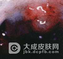 宝宝口腔粘膜病的护理