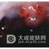 宝宝口腔粘膜病的护理
