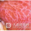 口腔粘膜病的表现