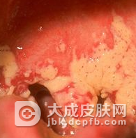 饮食导致口腔粘膜病