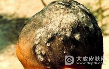 得了头癣怎么办 头癣怎么治疗