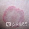 体癣患者饮食上必知的一些误区介绍