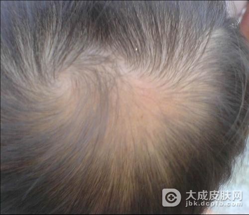 脱发危害大不大