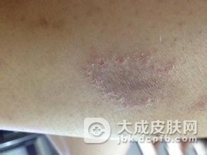体癣疾病会传染给自己的亲人吗