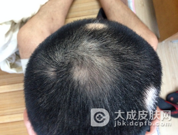 初期的脱发该怎么办