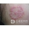 体癣在孕期要多加小心　　