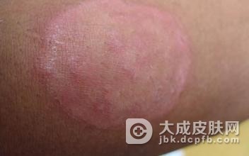 体癣这种疾病具体都有什么特征呢