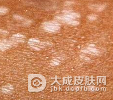 毛发苔藓的症状体征有哪些