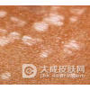 毛发苔藓的症状体征有哪些