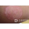 体癣这种疾病具体都有什么特征呢