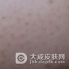 毛发苔藓患者的注意事项有哪些