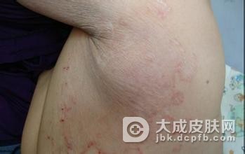 有关于体癣的发病特征