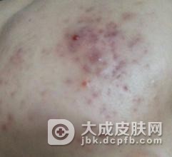 专家来介绍寻常型痤疮的症状表现有哪些