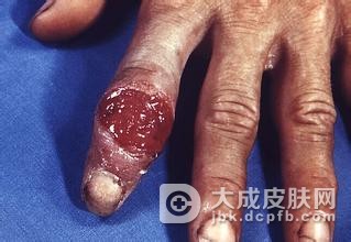 防止梅毒再次复发